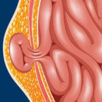 hernia-mesh Hernia Mesh Pain - Defective Medical Devices - Martin, Harding & Mazzotti 1800law1010
