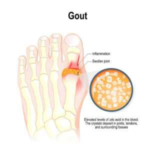 Uloric Lawsuit Gout Medicine