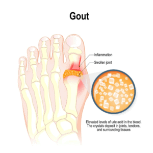 Uloric Recall - Uloric Lawsuit Gout Medicine - uloric class action lawsuit - gout medication lawsuit