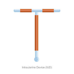 Image of a copper IUD, paragard lawsuit, paragard iud lawsuit, copper iud lawsuit