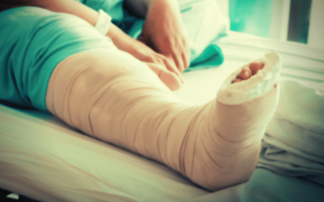Human leg in cast from motorcycle accident