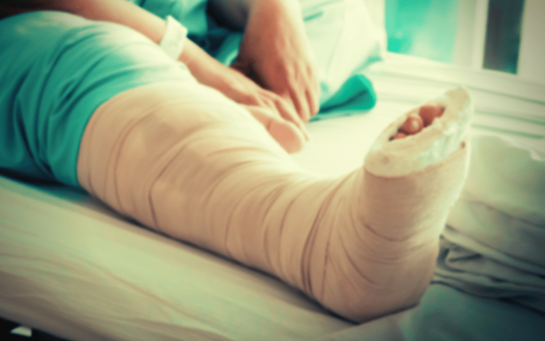 Leg In Cast Human leg in cast from motorcycle accident