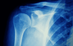 x-ray image of a shoulder