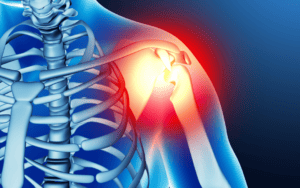 rendering of a shoulder x ray, pain radiating from the shoulder joint