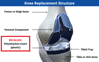 Exactech Recall - Knee Replacement Structure - Exactech Recall Lawyers