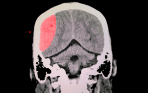 Traumatic Brain Injury - Brain Scan Image - Causes of Traumatic Brain Injury
