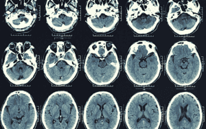 How Is Traumatic Brain Injury Diagnosed - Brain Scan - Diagnosing Traumatic Brain Injury - TBI