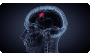 Depo-Provera Lawsuit - Meningioma Brain Tumor