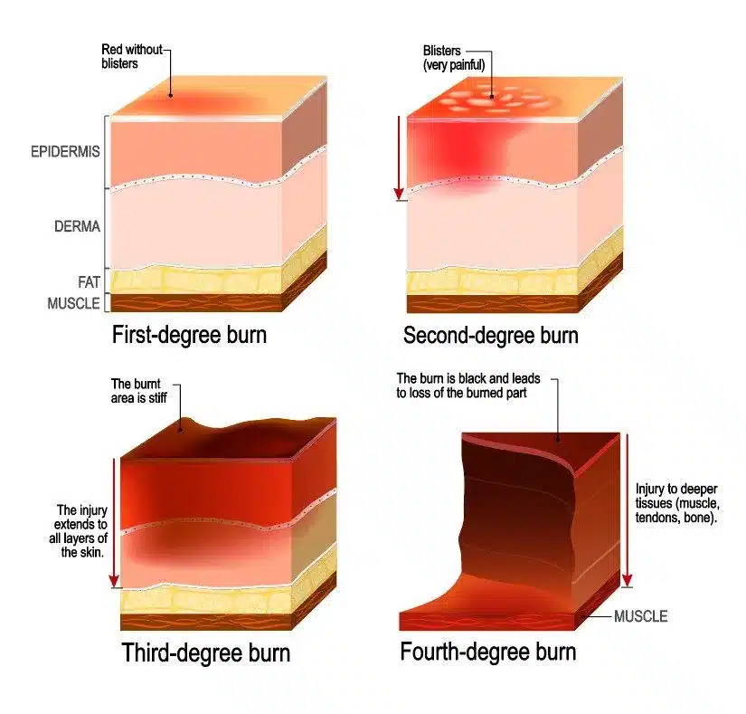 Burn Degree Examples
